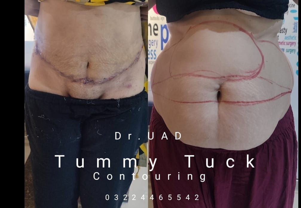 tummy-tuck-abdominoplasty-firmer-abdomen