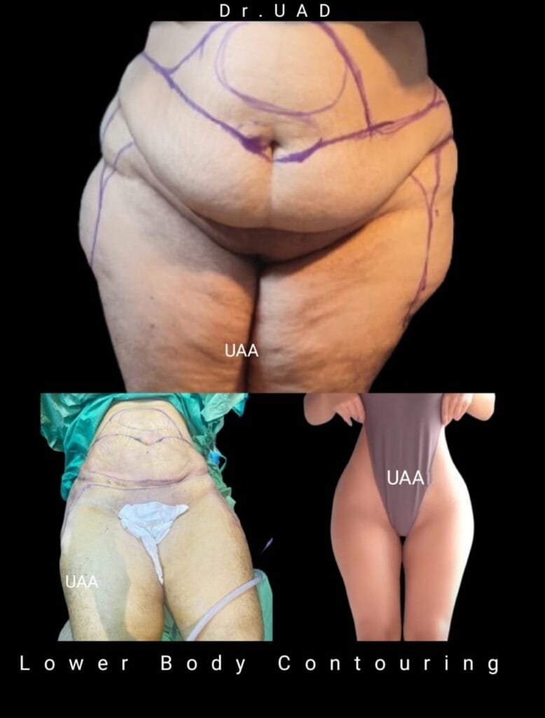 tummy-tuck-abdominoplasty-firmer-abdomen