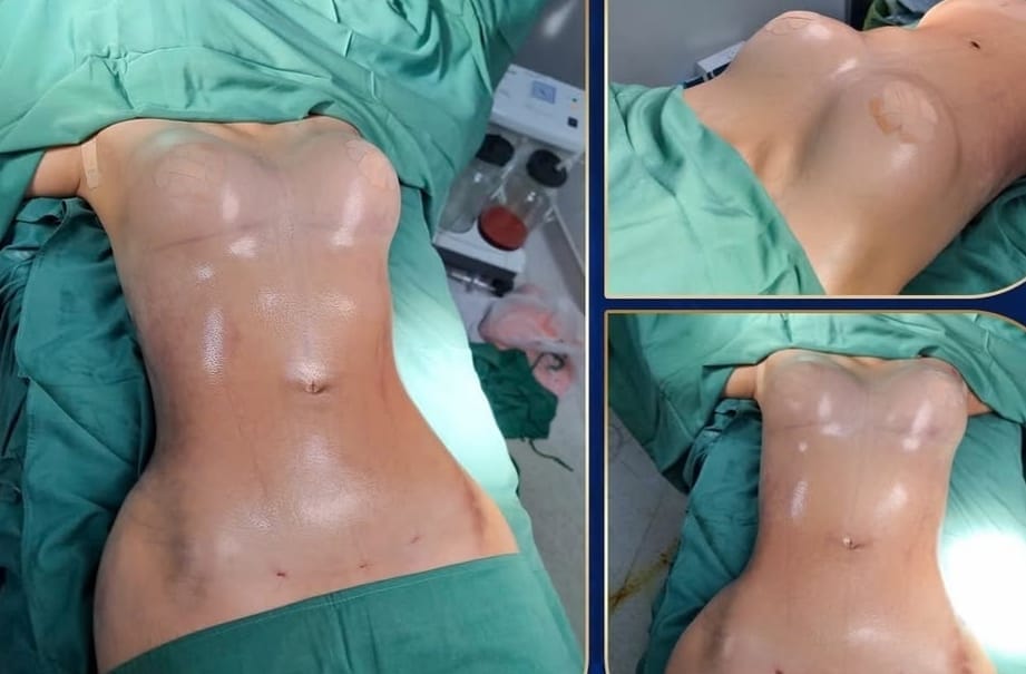 tummy-tuck-abdominoplasty-firmer-abdomen
