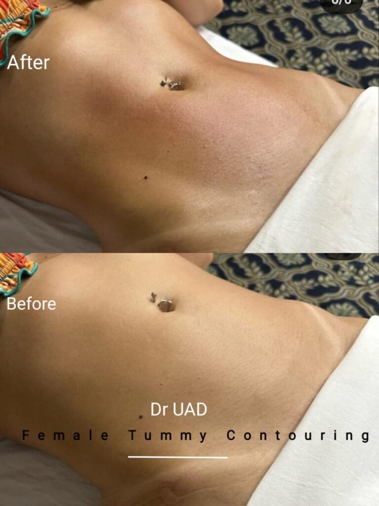 tummy-tuck-abdominoplasty-firmer-abdomen