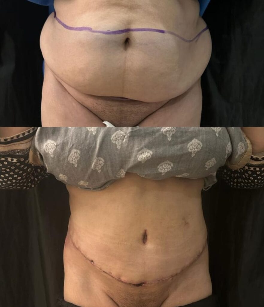 tummy-tuck-abdominoplasty-firmer-abdomen