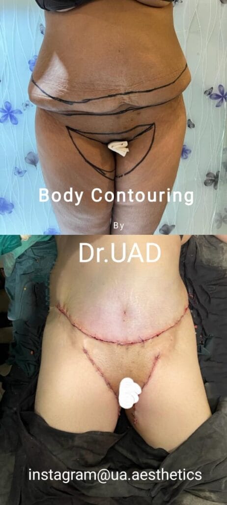 tummy-tuck-abdominoplasty-firmer-abdomen