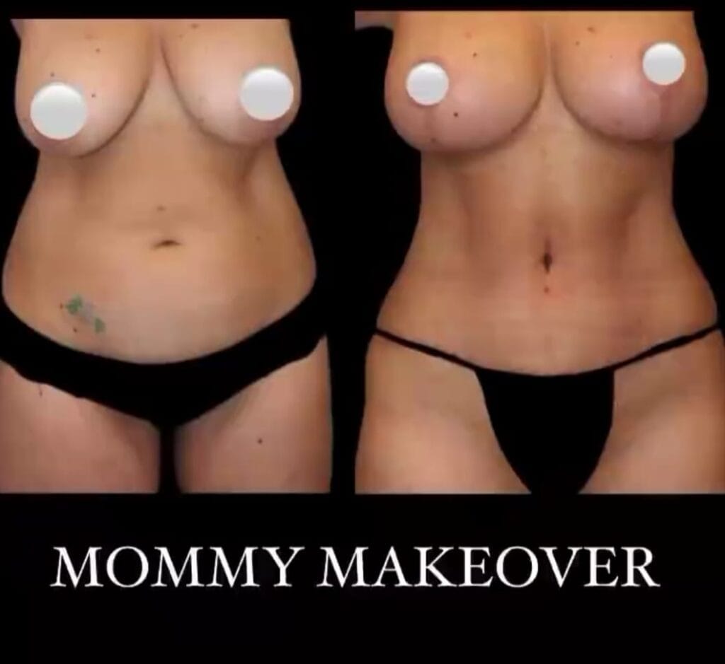tummy-tuck-abdominoplasty-firmer-abdomen