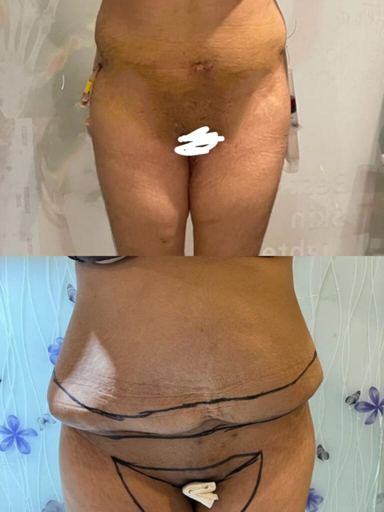 tummy-tuck-abdominoplasty-firmer-abdomen