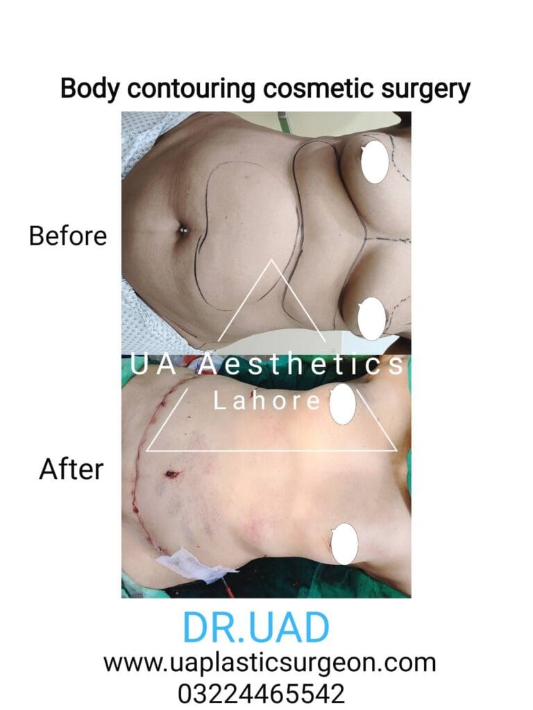 tummy-tuck-abdominoplasty-firmer-abdomen
