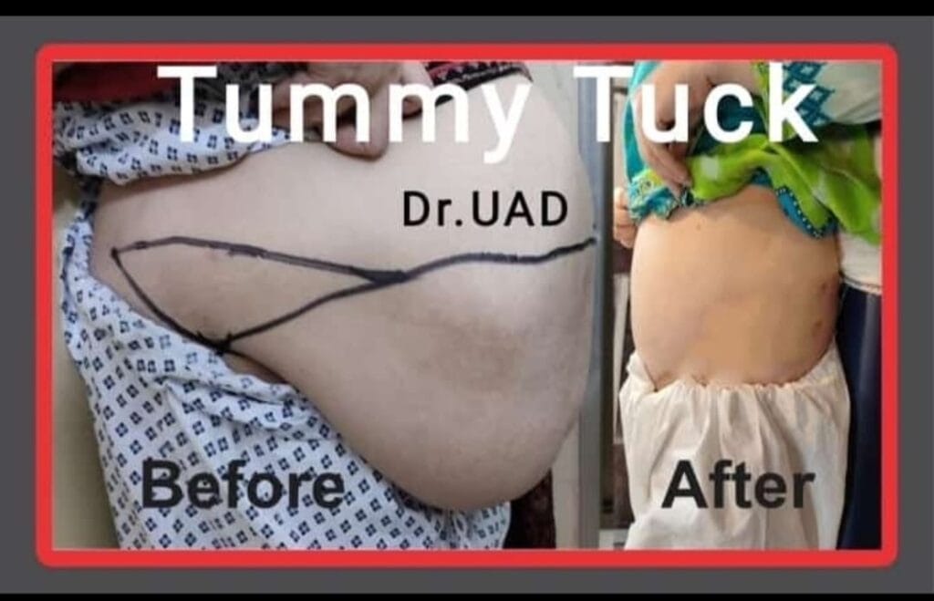 tummy-tuck-abdominoplasty-firmer-abdomen