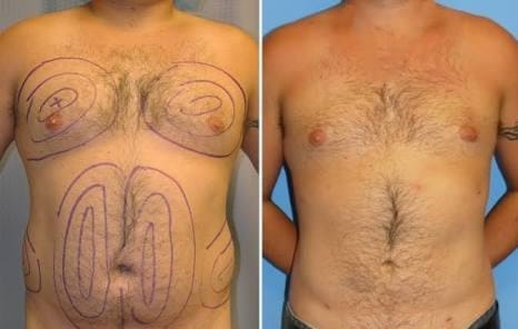 Tummy-Tuck-uad-aesthetics