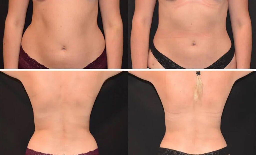 Liposuction